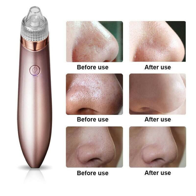 Unisex Electric Blackhead Pore Cleaner Acne Pimple Remover Strong Suction Tool - NeraVault