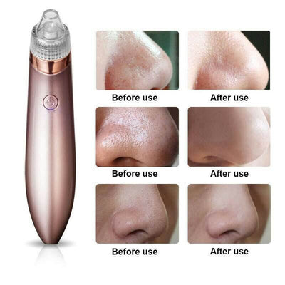 Unisex Electric Blackhead Pore Cleaner Acne Pimple Remover Strong Suction Tool - NeraVault
